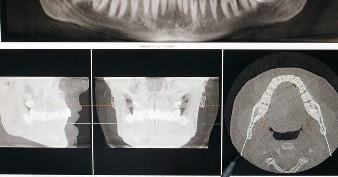 TMJ Dysfunction & the Cranial System: An Osteopathic Perspective