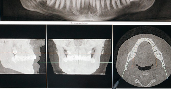 TMJ Dysfunction & the Cranial System: An Osteopathic Perspective